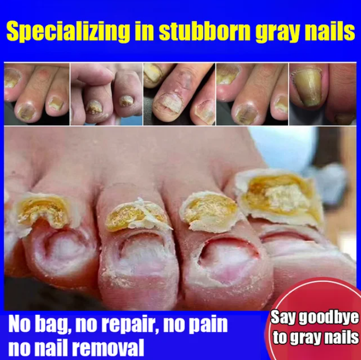 LAST DAY OF DISCOUNT 🔥 Fungal Nail Treatment Cream