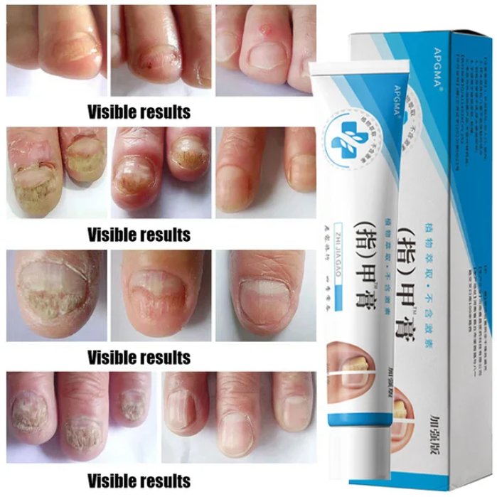 LAST DAY OF DISCOUNT 🔥 Fungal Nail Treatment Cream